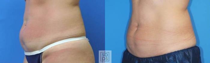 Before & After CoolSculpting Case 139 View #2 View in Torrance, CA