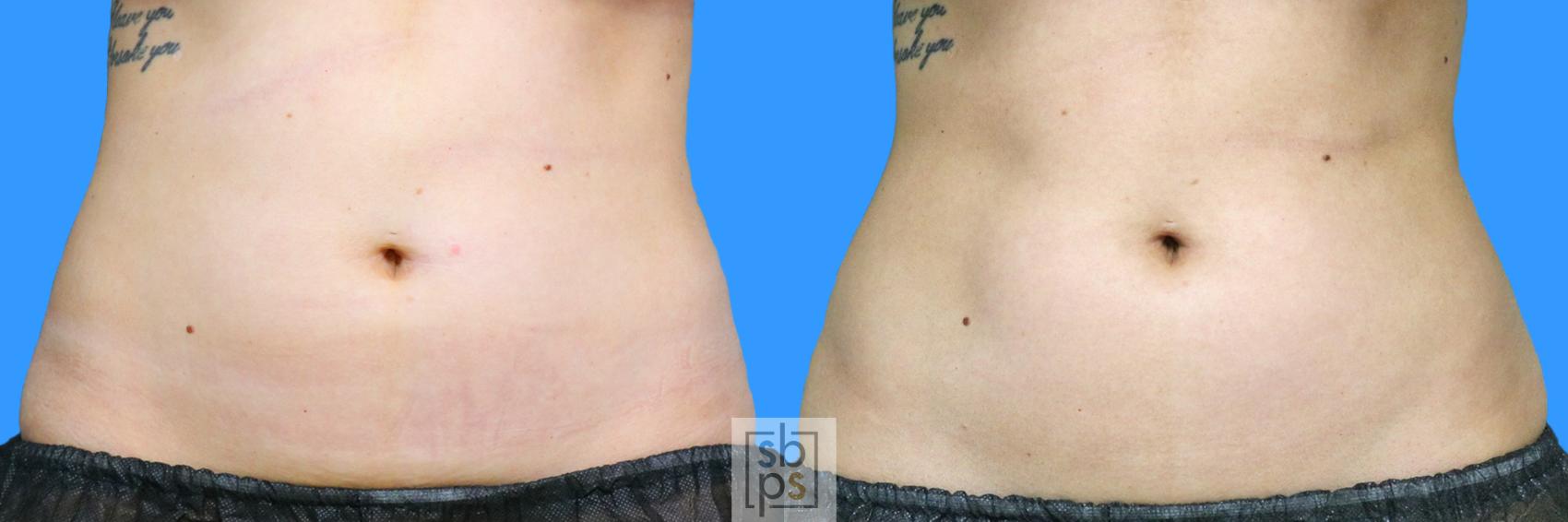Before & After CoolSculpting Case 223 View #1 View in Torrance, CA