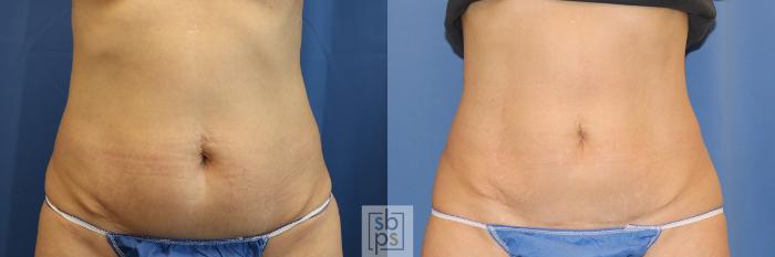 Before & After CoolSculpting Case 396 Front View in Torrance, CA