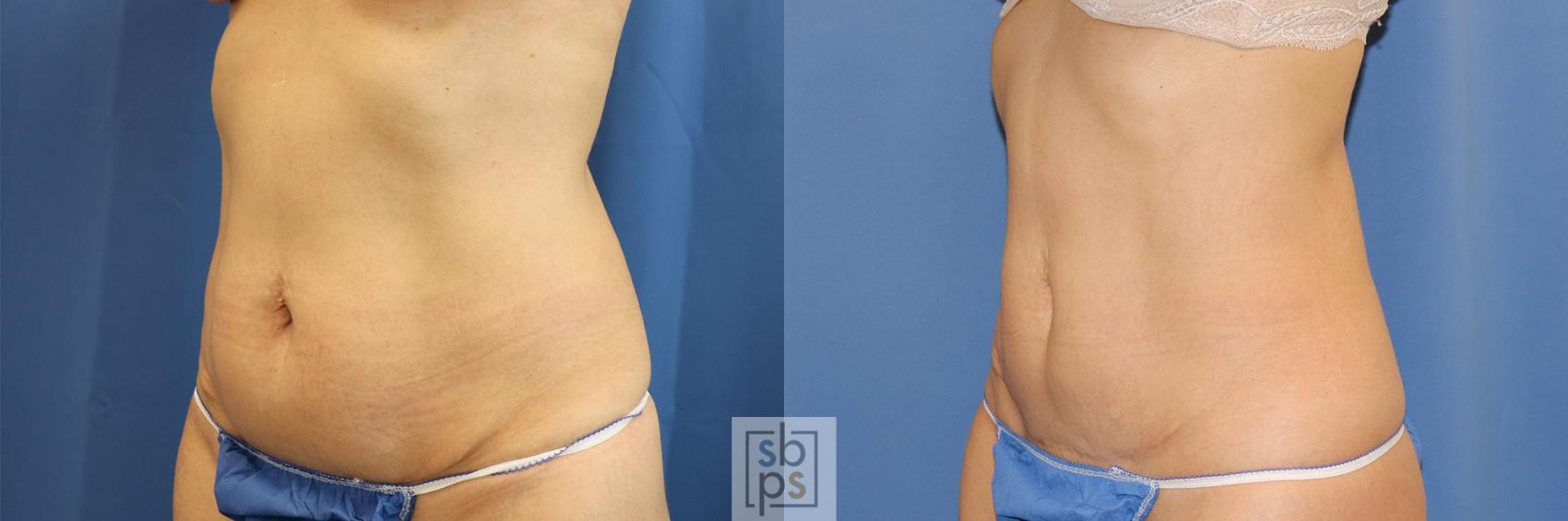 Before & After CoolSculpting Case 396 Left Oblique View in Torrance, CA