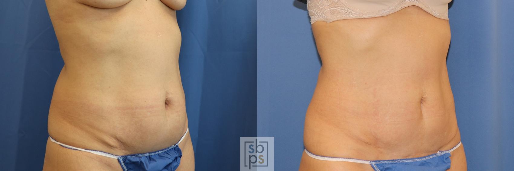 Before & After CoolSculpting Case 396 Right Oblique View in Torrance, CA