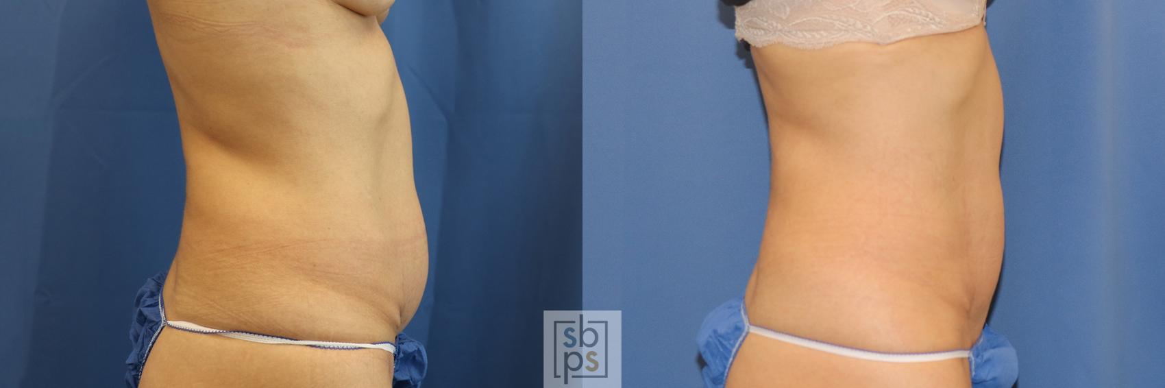 Before & After CoolSculpting Case 396 Right Side View in Torrance, CA