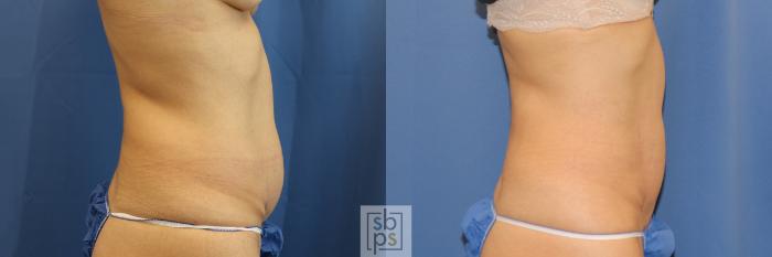 Before & After CoolSculpting Case 396 Right Side View in Torrance, CA