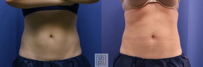 Before & After CoolSculpting Case 398 Front View in Torrance, CA