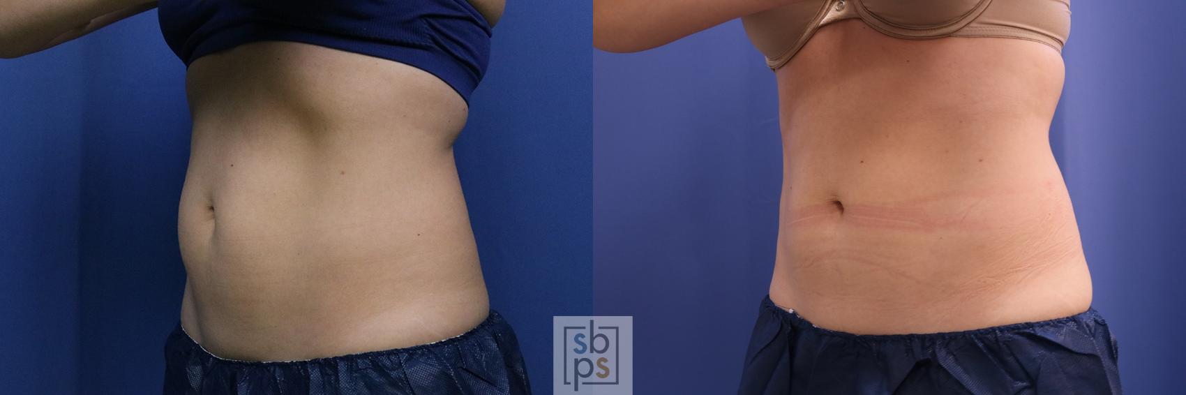 Before & After CoolSculpting Case 398 Left Oblique View in Torrance, CA