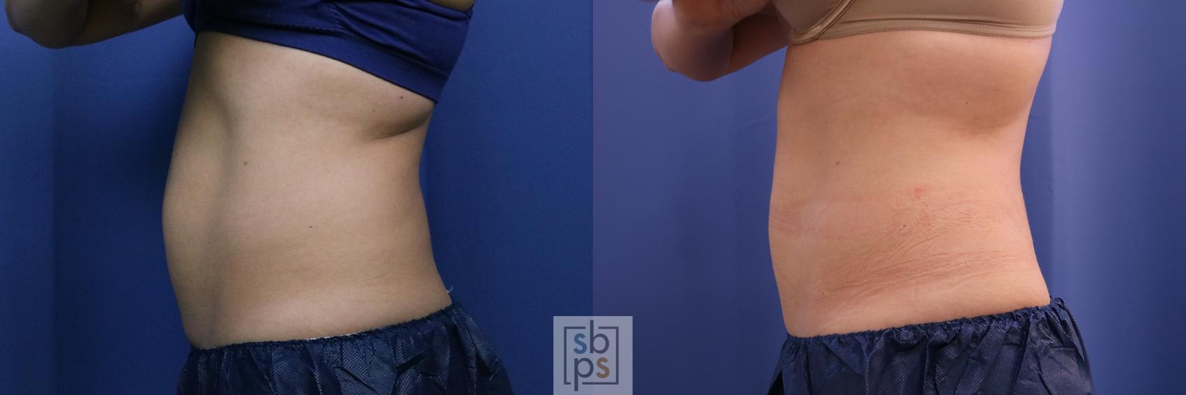 Before & After CoolSculpting Case 398 Left Side View in Torrance & Los Angeles, CA, CA