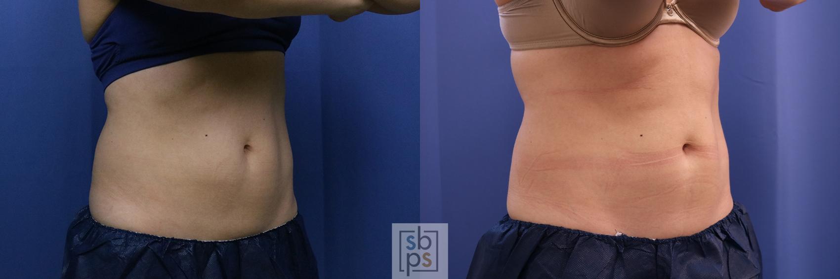 Before & After CoolSculpting Case 398 Right Oblique View in Torrance, CA