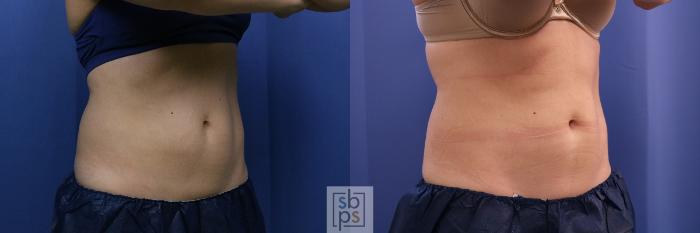 Before & After CoolSculpting Case 398 Right Oblique View in Torrance, CA