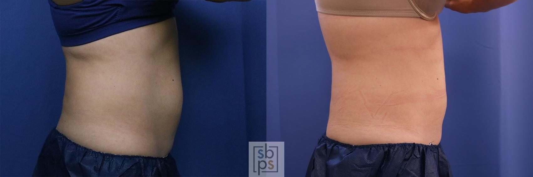 Before & After CoolSculpting Case 398 Right Side View in Torrance, CA