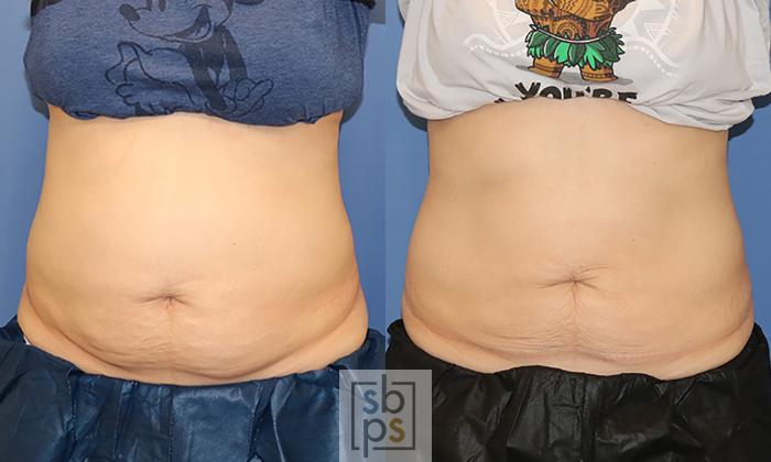 Before & After CoolSculpting Case 413 Front View in Torrance, CA