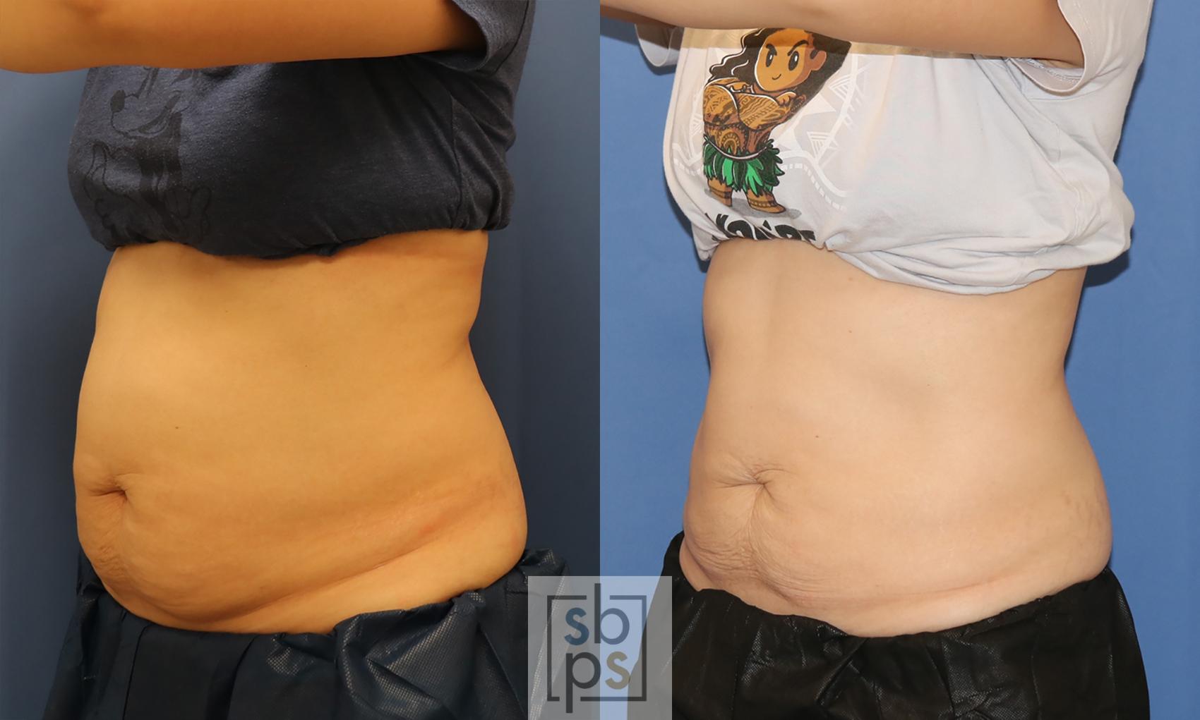 Before & After CoolSculpting Case 413 Left Oblique View in Torrance & Los Angeles, CA, CA