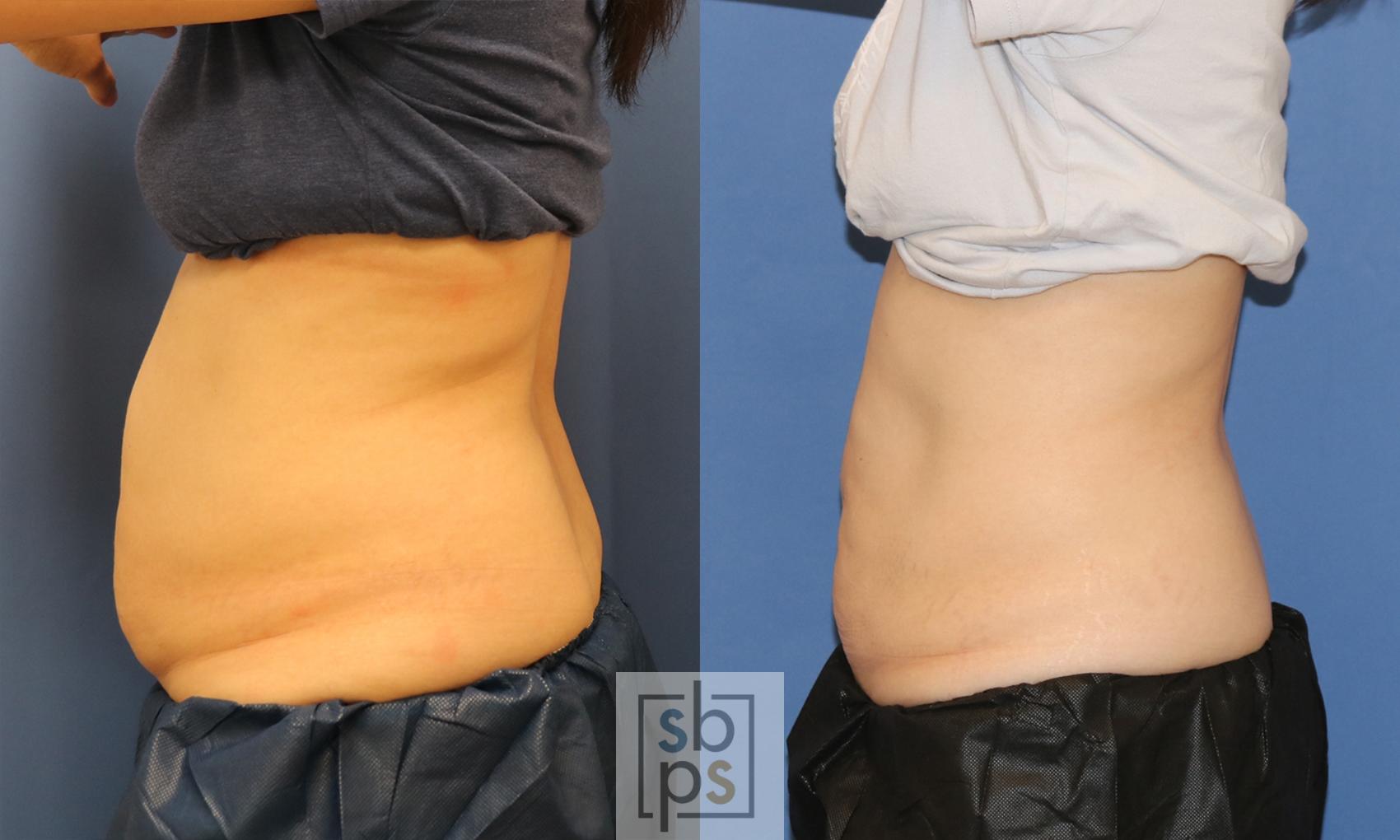 Before & After CoolSculpting Case 413 Left Side View in Torrance, CA