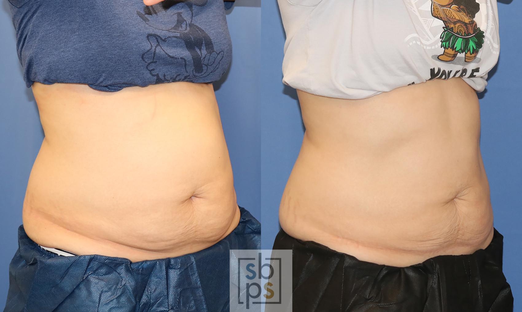 Before & After CoolSculpting Case 413 Right Oblique View in Torrance, CA