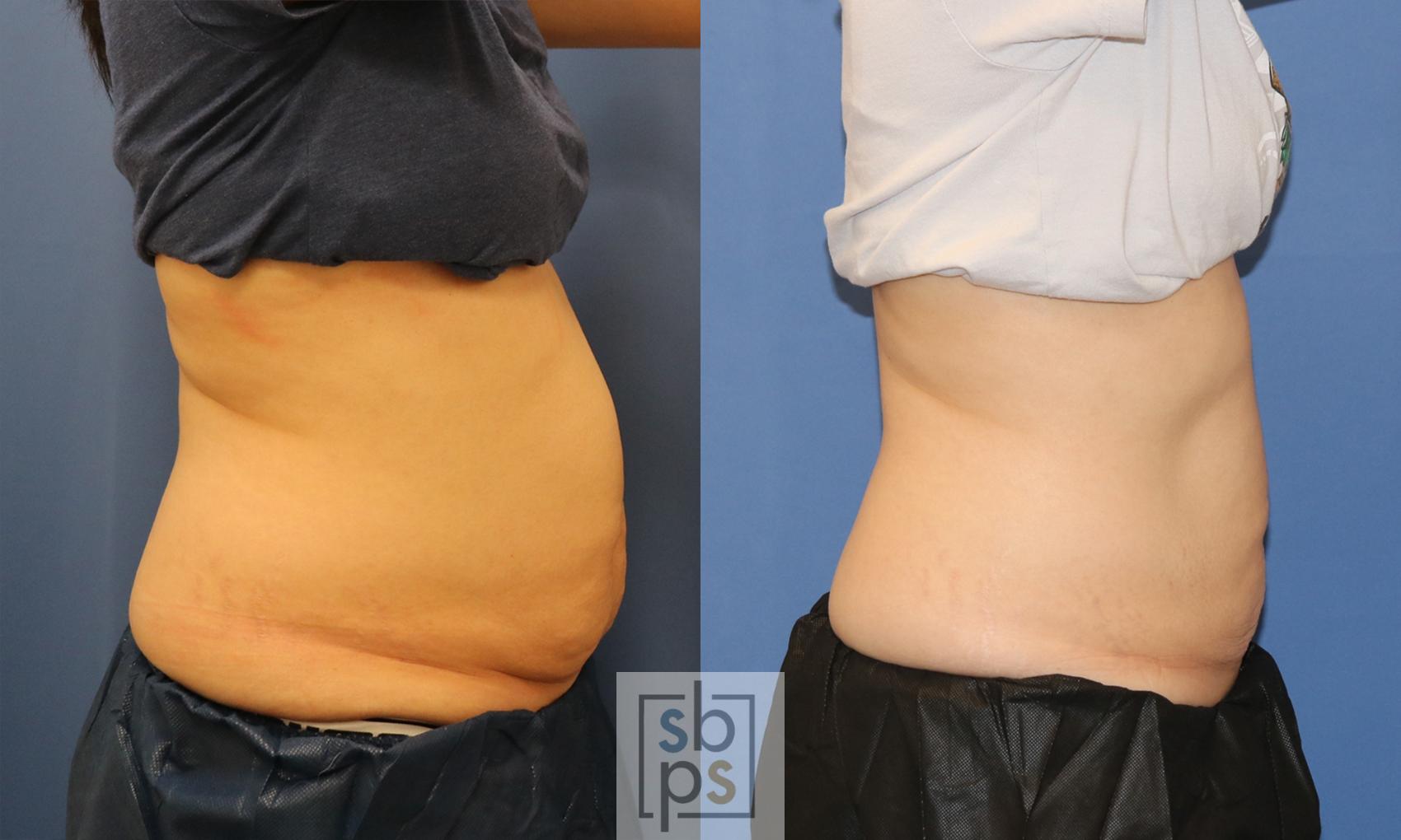 Before & After CoolSculpting Case 413 Right Side View in Torrance, CA