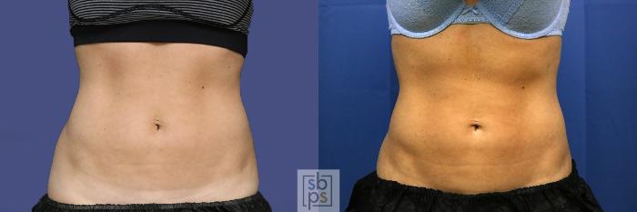 Before & After CoolSculpting Case 436 Front View in Torrance, CA