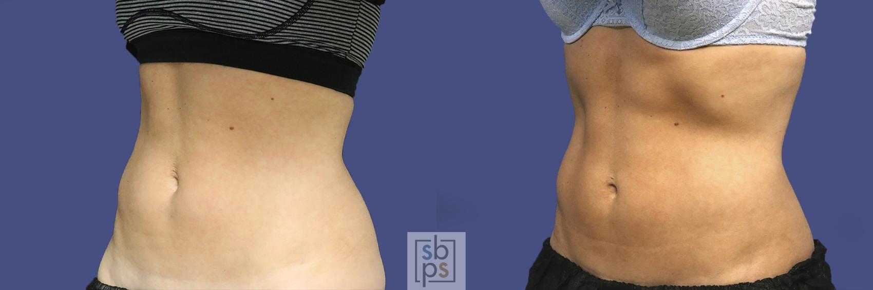 Before & After CoolSculpting Case 436 Left Oblique View in Torrance, CA