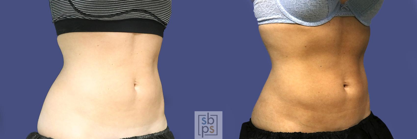 Before & After CoolSculpting Case 436 Right Oblique View in Torrance, CA