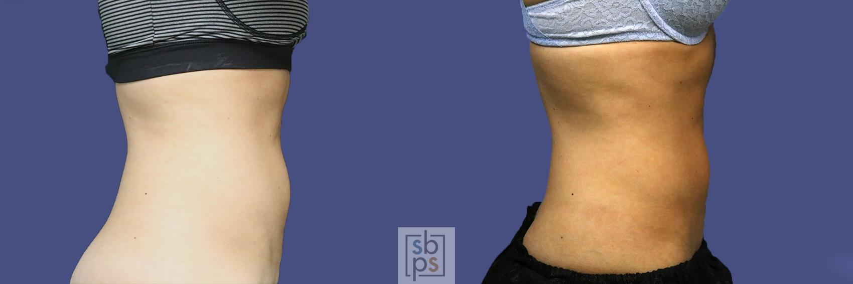 Before & After CoolSculpting Case 436 Right Side View in Torrance, CA