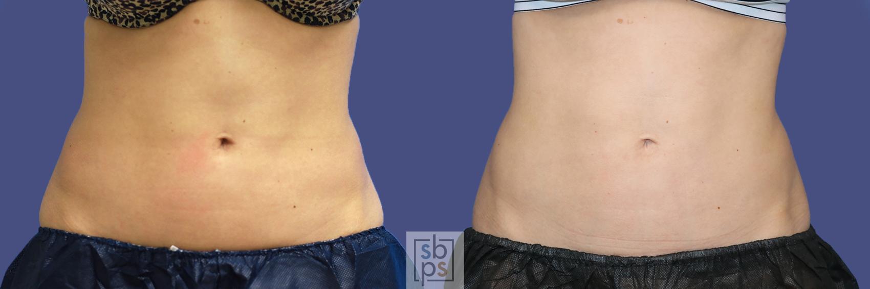 Before & After CoolSculpting Case 437 Front View in Torrance, CA