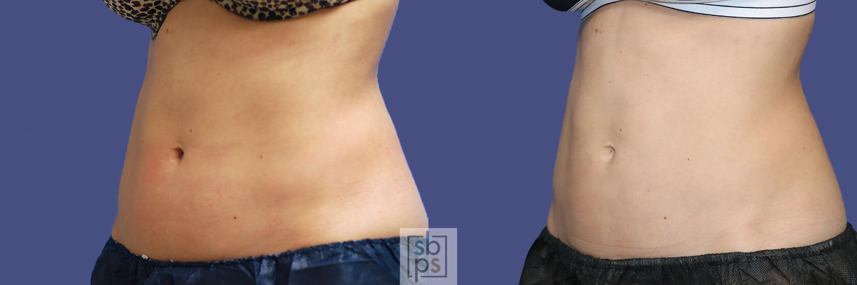Before & After CoolSculpting Case 437 Left Oblique View in Torrance, CA