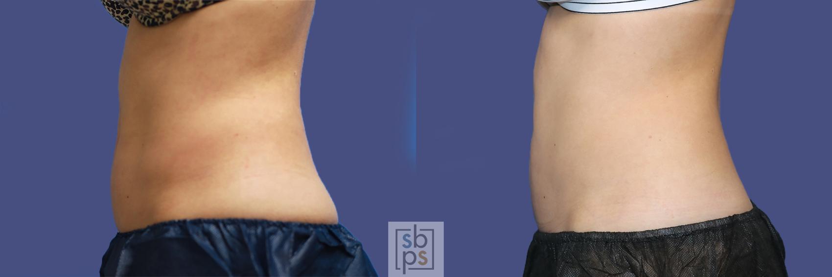 Before & After CoolSculpting Case 437 Left Side View in Torrance, CA