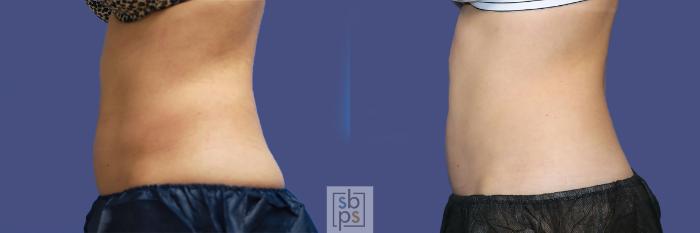 Before & After CoolSculpting Case 437 Left Side View in Torrance, CA