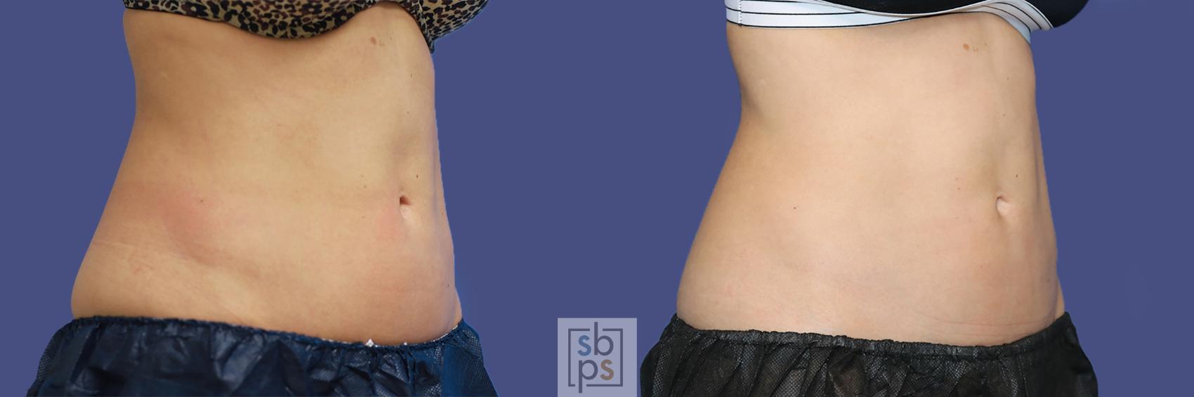 Before & After CoolSculpting Case 437 Right Oblique View in Torrance, CA