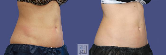 Before & After CoolSculpting Case 437 Right Oblique View in Torrance, CA