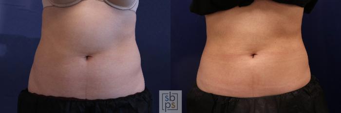 Before & After CoolSculpting Case 518 Front View in Torrance, CA