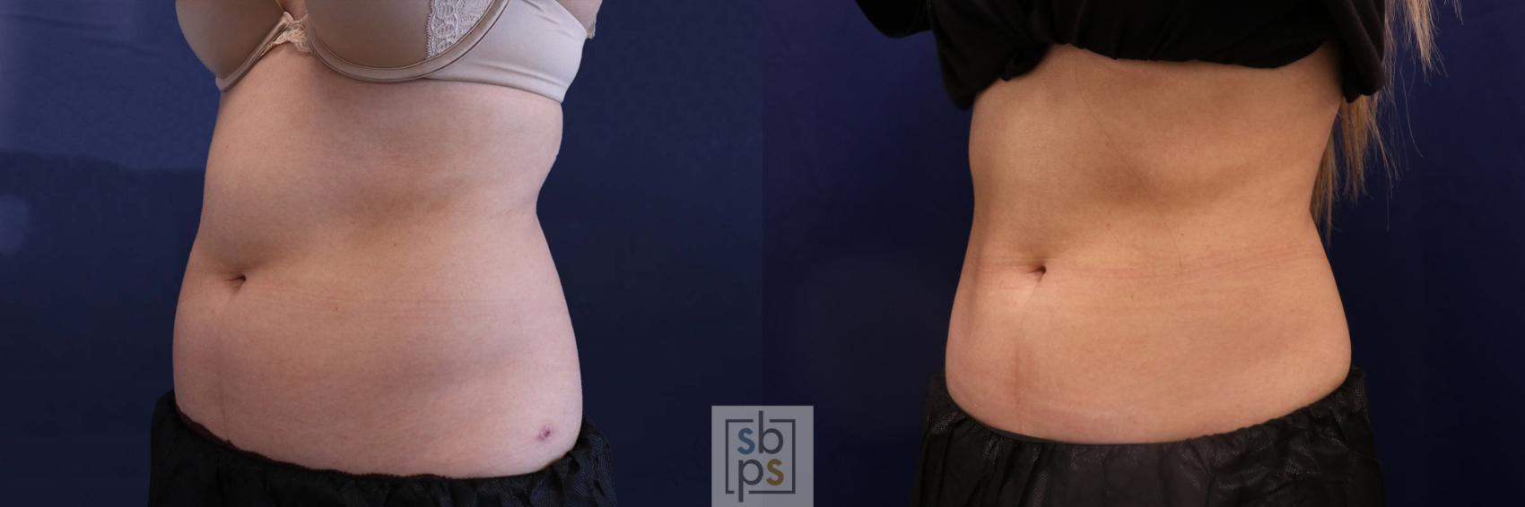 Before & After CoolSculpting Case 518 Left Oblique View in Torrance, CA