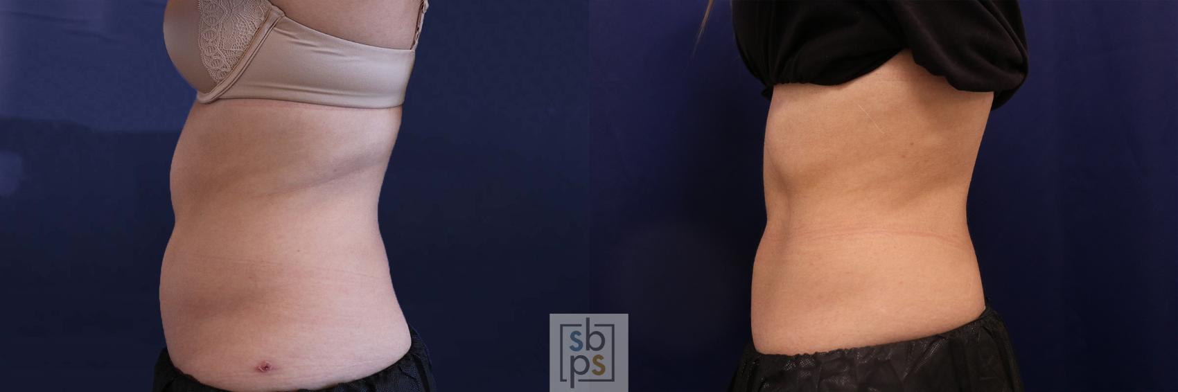 Before & After CoolSculpting Case 518 Left Side View in Torrance, CA