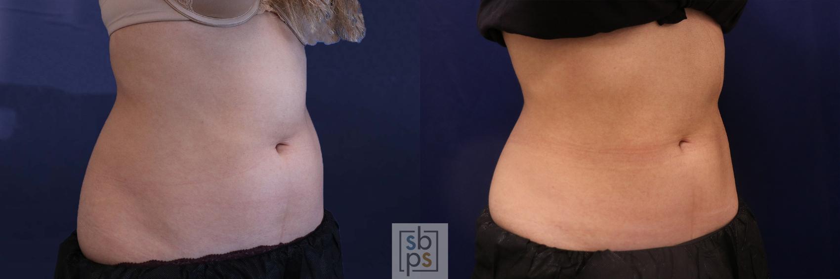 Before & After CoolSculpting Case 518 Right Oblique View in Torrance, CA