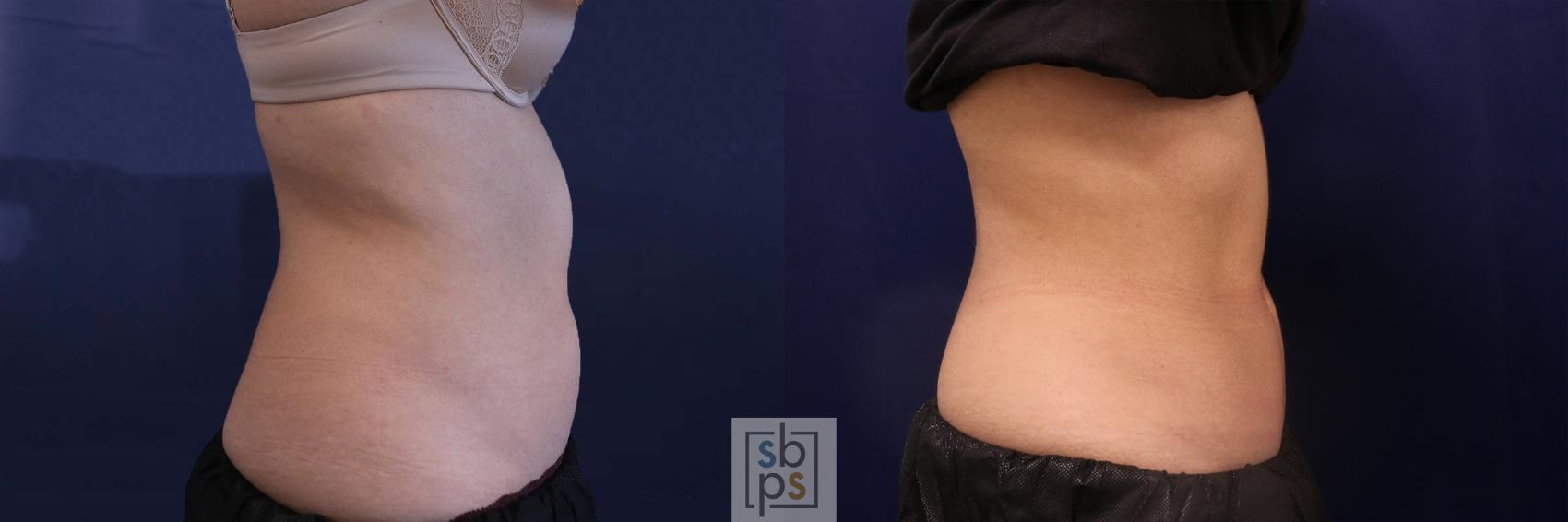 Before & After CoolSculpting Case 518 Right Side View in Torrance, CA