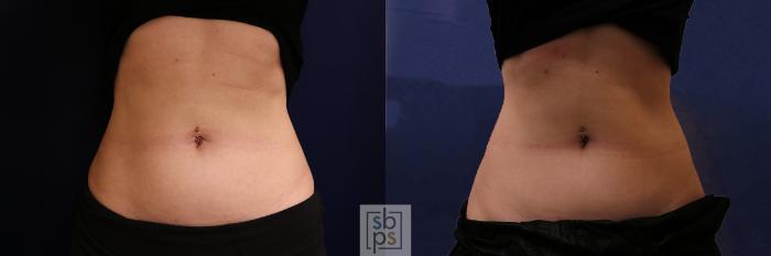 Before & After CoolSculpting Case 592 Front View in Torrance, CA