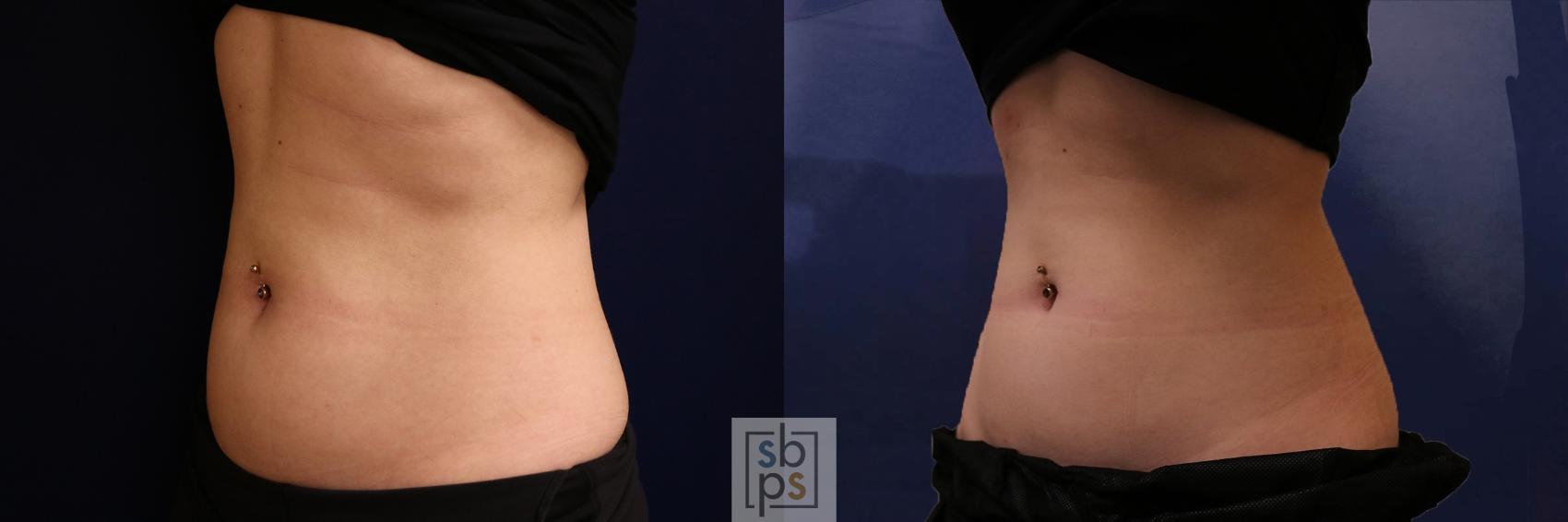 Before & After CoolSculpting Case 592 Left Oblique View in Torrance, CA