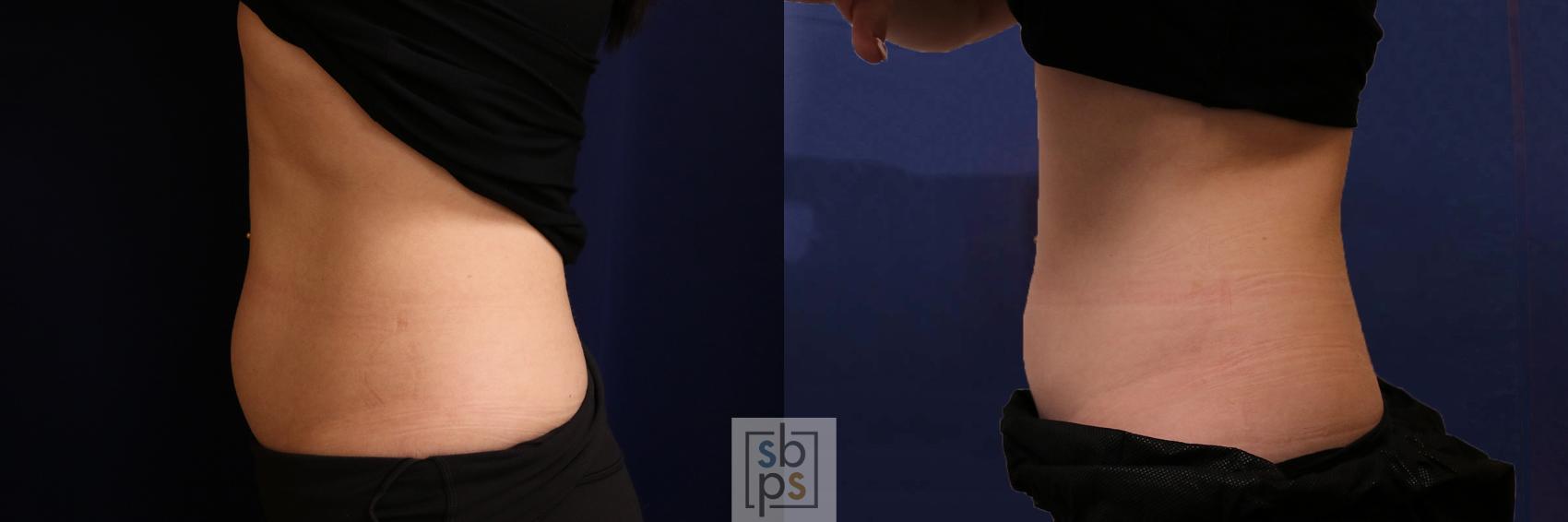 Before & After CoolSculpting Case 592 Left Side View in Torrance, CA