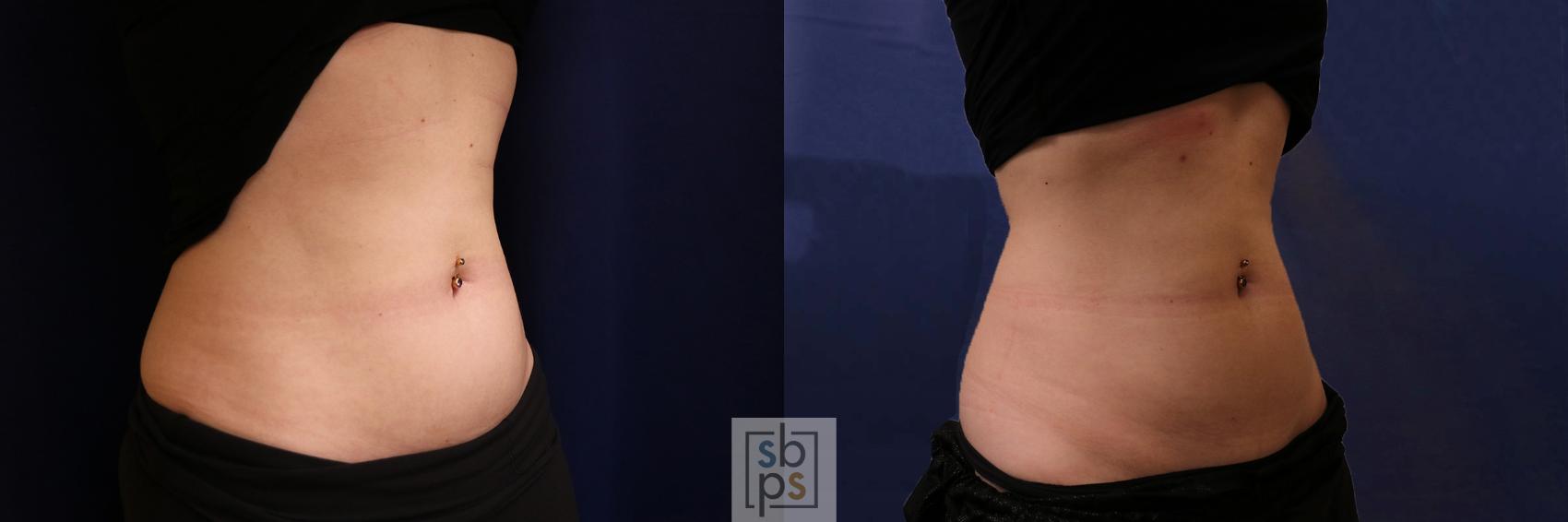 Before & After CoolSculpting Case 592 Right Oblique View in Torrance, CA