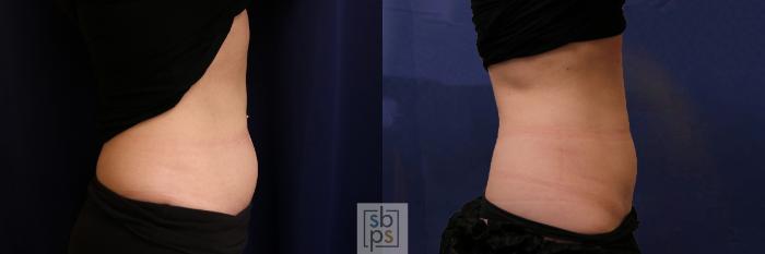 Before & After CoolSculpting Case 592 Right Side View in Torrance, CA