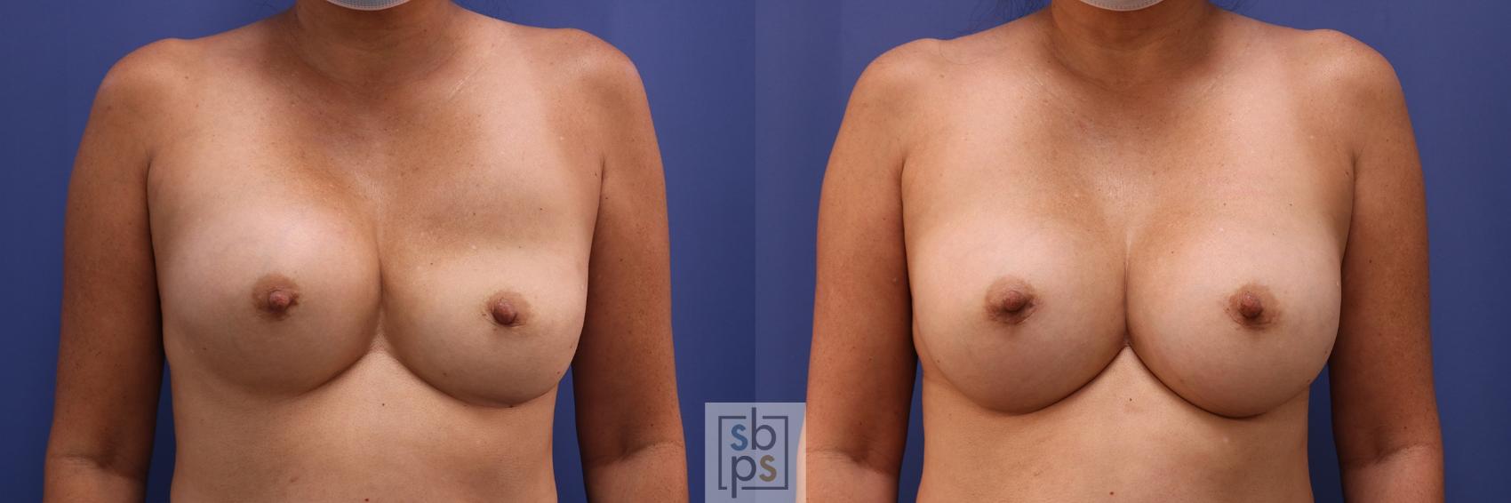 Before & After Corrective Breast Surgery Case 451 Front View in Los Angeles & Torrance, CA, CA