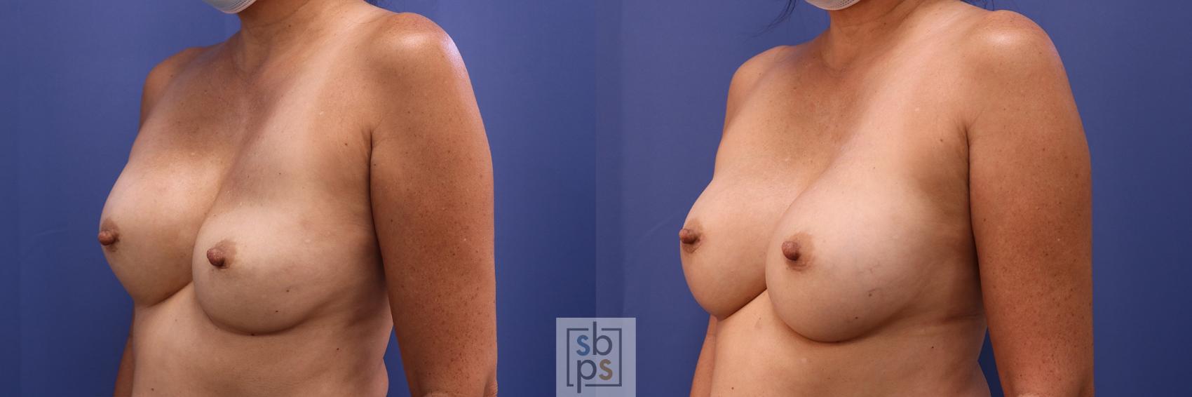 Before & After Corrective Breast Surgery Case 451 Left Oblique View in Torrance & Los Angeles, CA, CA