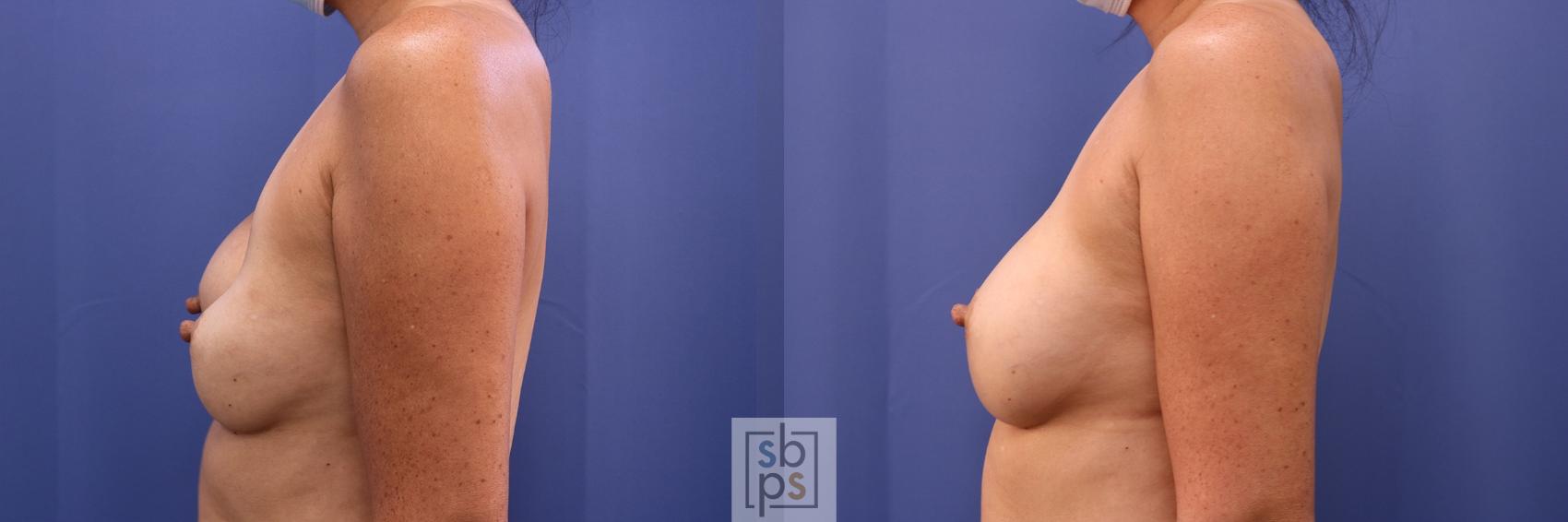 Before & After Corrective Breast Surgery Case 451 Left Side View in Torrance & Los Angeles, CA, CA