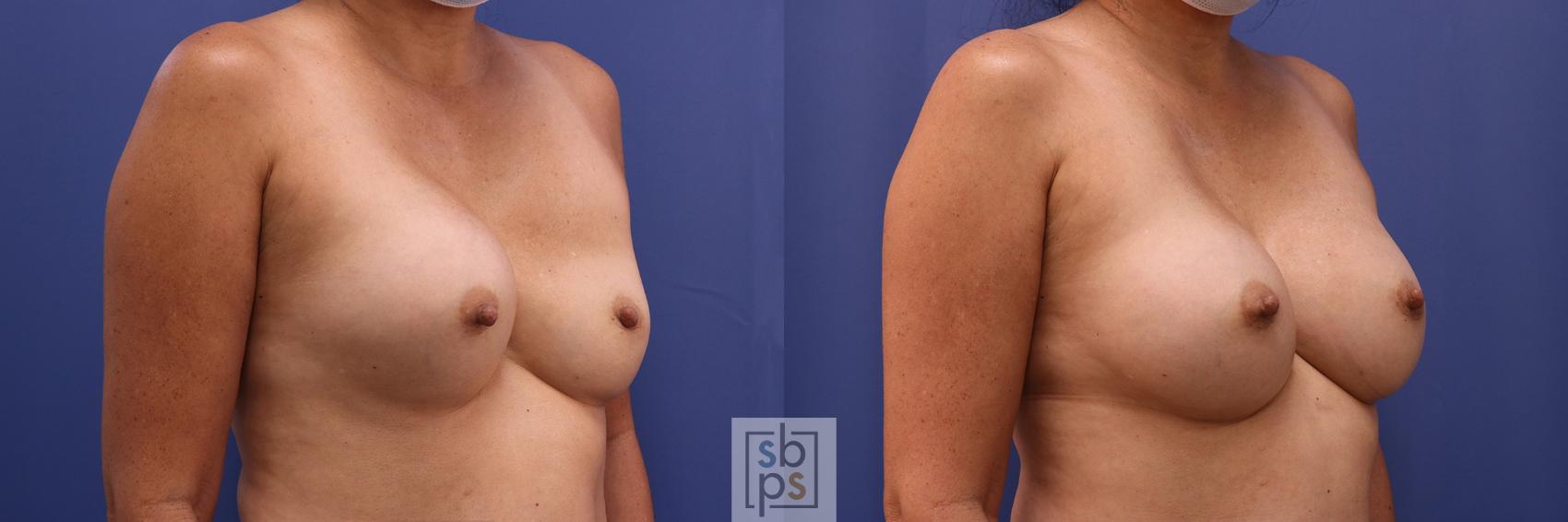 Before & After Corrective Breast Surgery Case 451 Right Oblique View in Torrance & Los Angeles, CA, CA