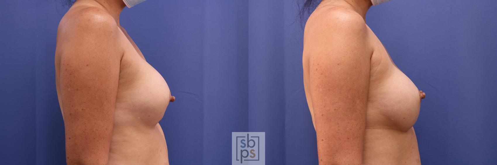 Before & After Corrective Breast Surgery Case 451 Right Side View in Torrance & Los Angeles, CA, CA