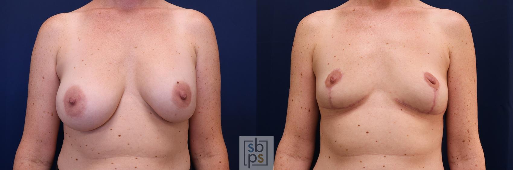 Before & After Corrective Breast Surgery Case 627 Front View in Los Angeles & Torrance, CA, CA