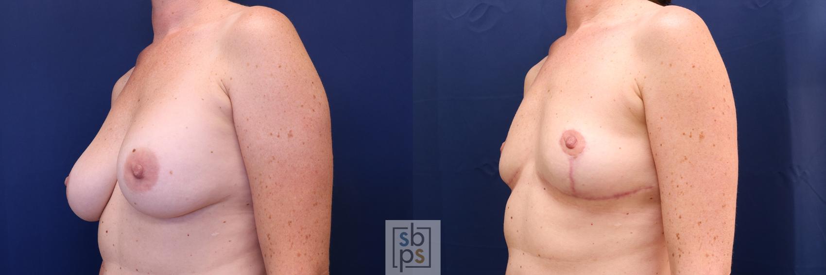 Before & After Corrective Revision Breast Surgery Case 627 Left Oblique View in Los Angeles, Torrance & Long Beach, CA