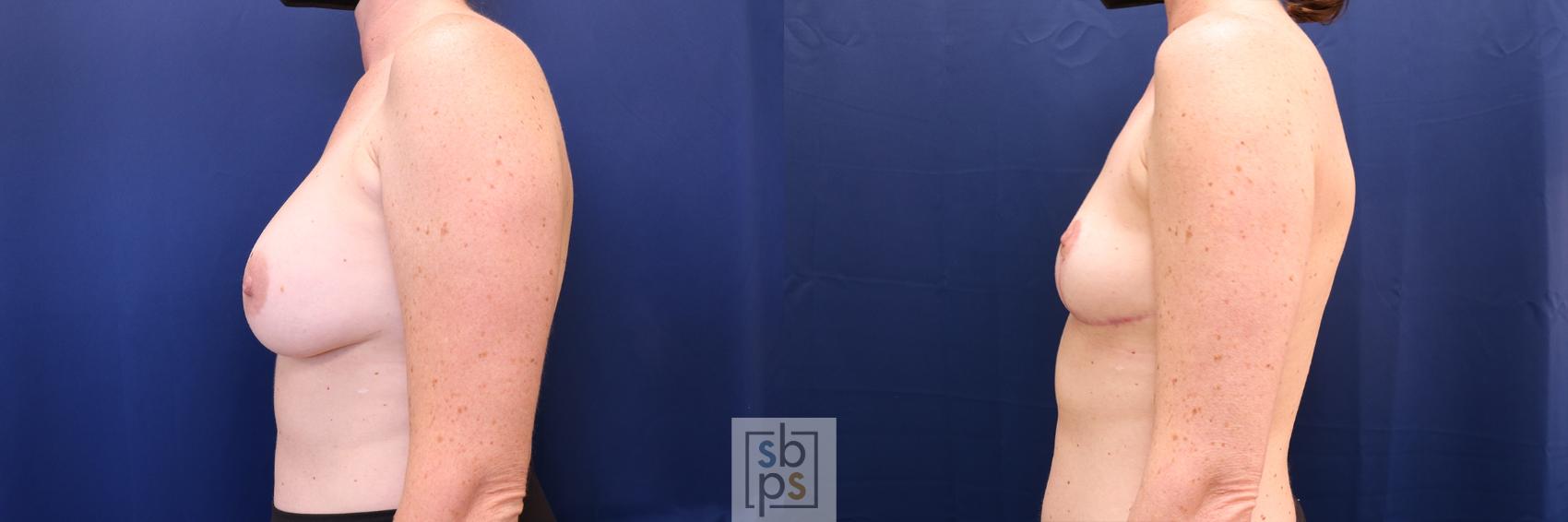 Before & After Corrective Revision Breast Surgery Case 627 Left Side View in Los Angeles, Torrance & Long Beach, CA