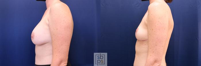 Before & After Corrective Breast Surgery Case 627 Left Side View in Los Angeles & Torrance, CA, CA