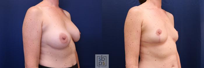 Before & After Corrective Breast Surgery Case 627 Right Oblique View in Los Angeles & Torrance, CA, CA