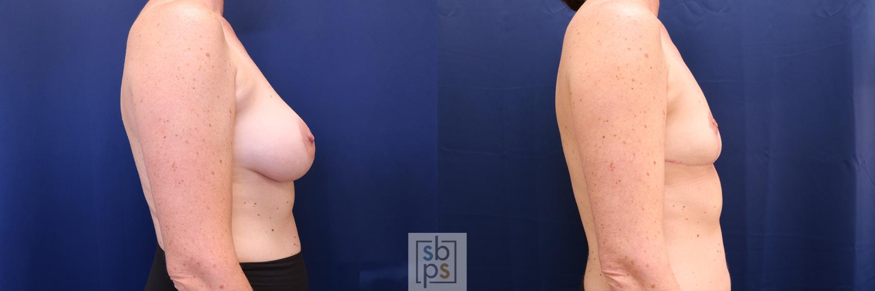 Before & After Corrective Revision Breast Surgery Case 627 Right Side View in Los Angeles, Torrance & Long Beach, CA