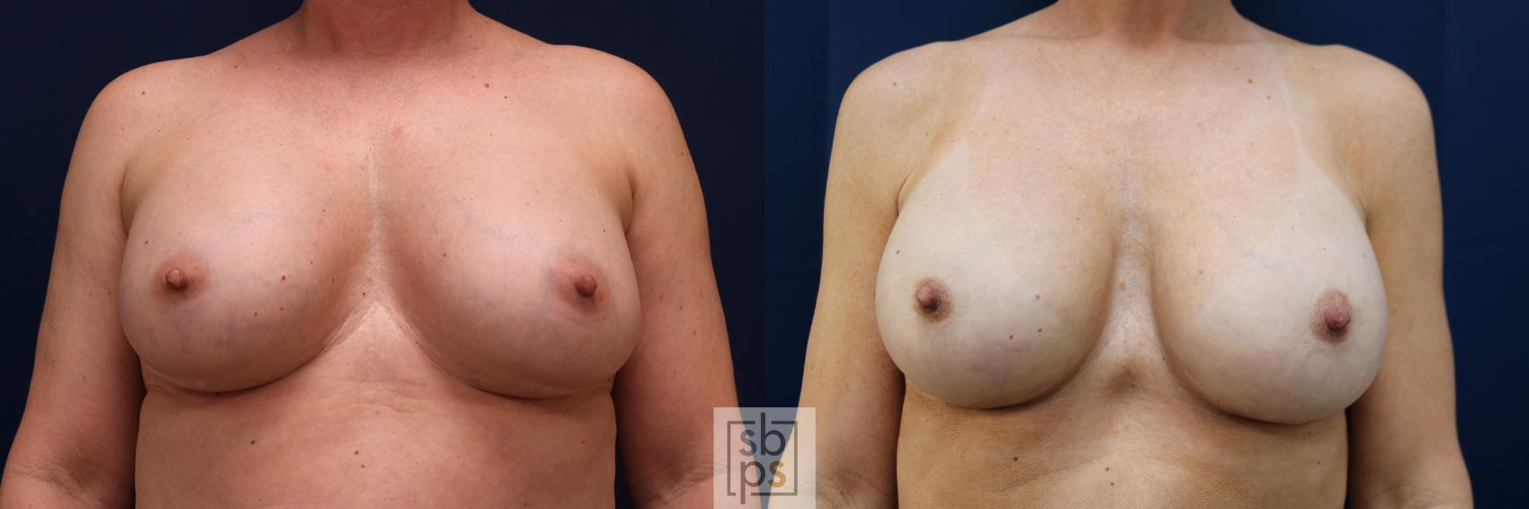 Before & After Corrective Breast Surgery Case 643 Front View in Los Angeles & Torrance, CA, CA